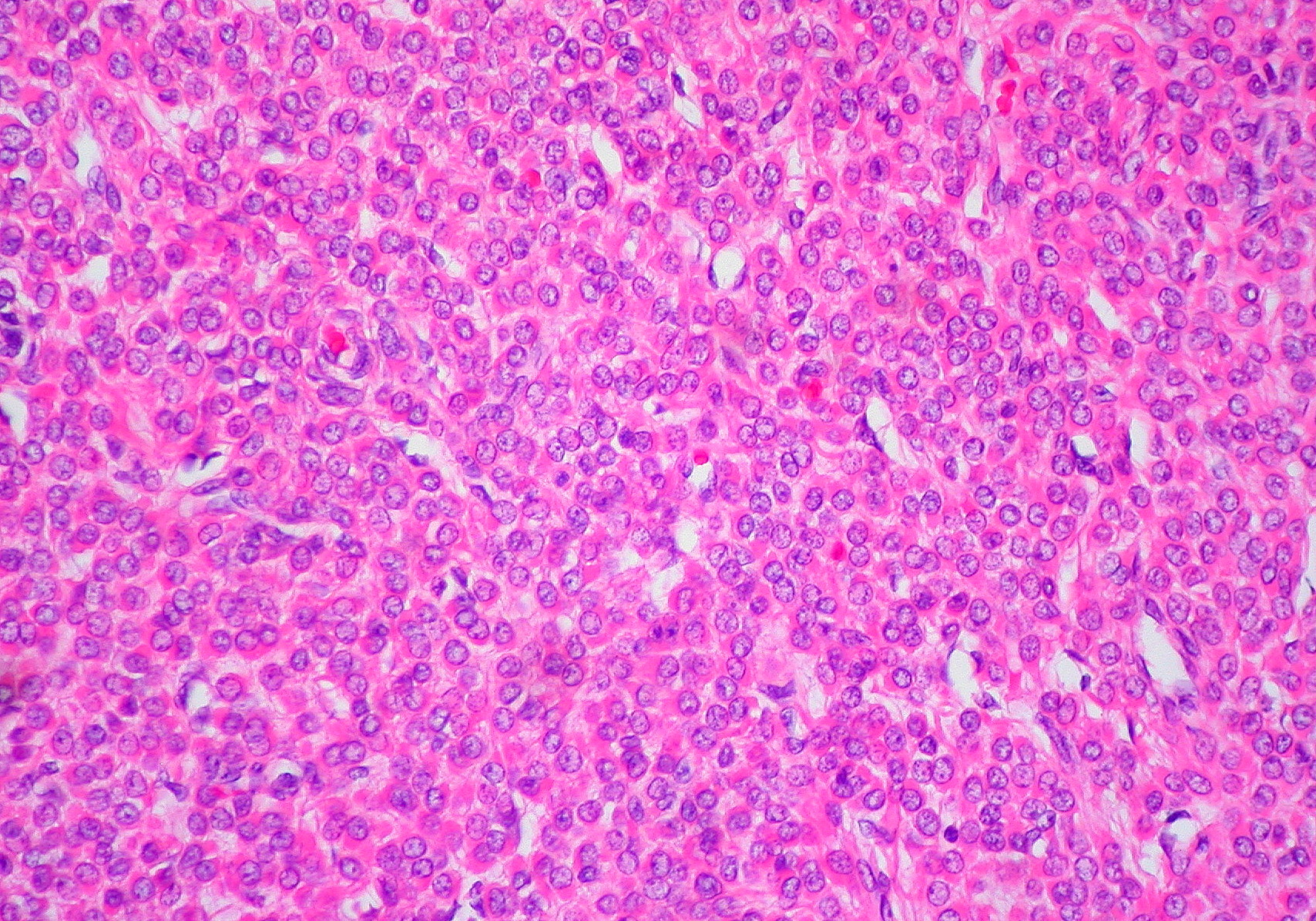 Epitheloides Leiomyom Uterus
